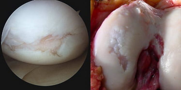 osteoartrita deformatoare a articulației genunchiului stâng artrita precoce